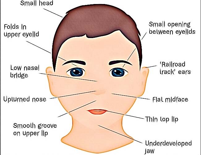 Fetal Alcohol Syndrome in Adults, Signs and Symptoms