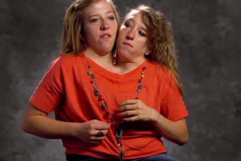 Conjoined Twins Brittany and Abby